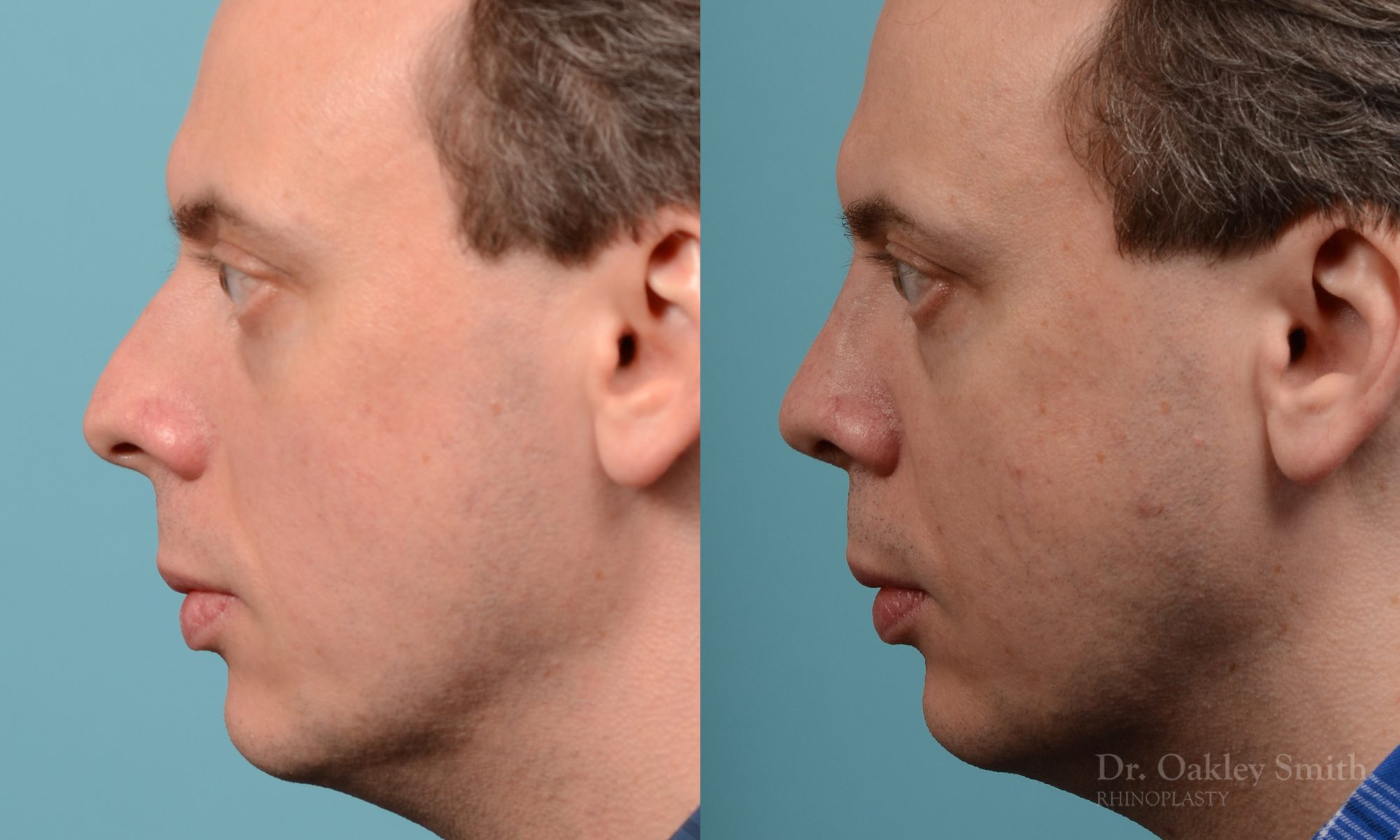 male nose rhinoplasty curved nose