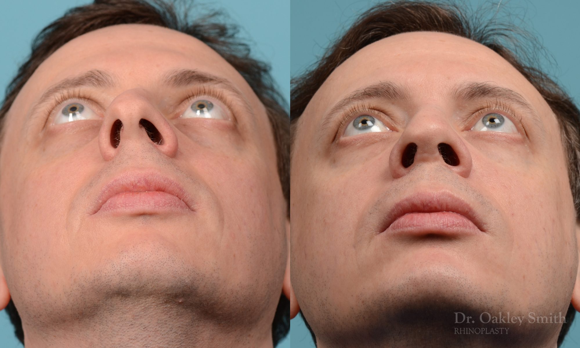 male nose rhinoplasty curved nose