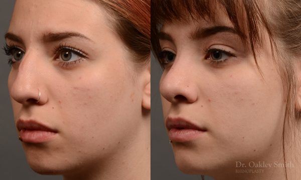female rhinoplasty to straigthen her nose