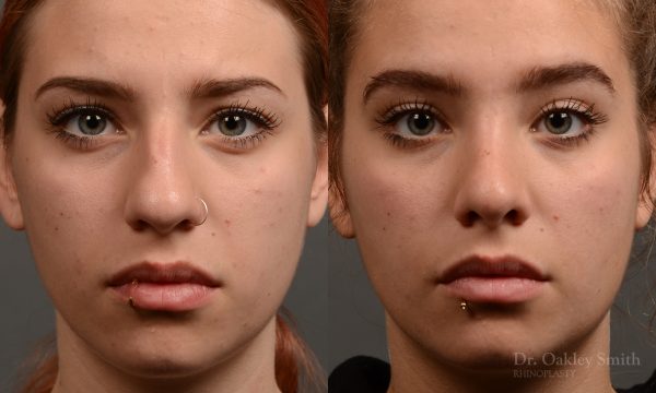 rhinoplasty Nothing demonstrates the skillful craftsmanship that Dr. Oakley Smith accomplishes during his surgeries than a collection of before and after case studies. As one of a hand full of surgeons in North America who limits his practice to only Rhinoplasty surgery, it is obvious that he has mastered his art. There is no question why he is one of the busiest cosmetic nose job surgeons in the country.