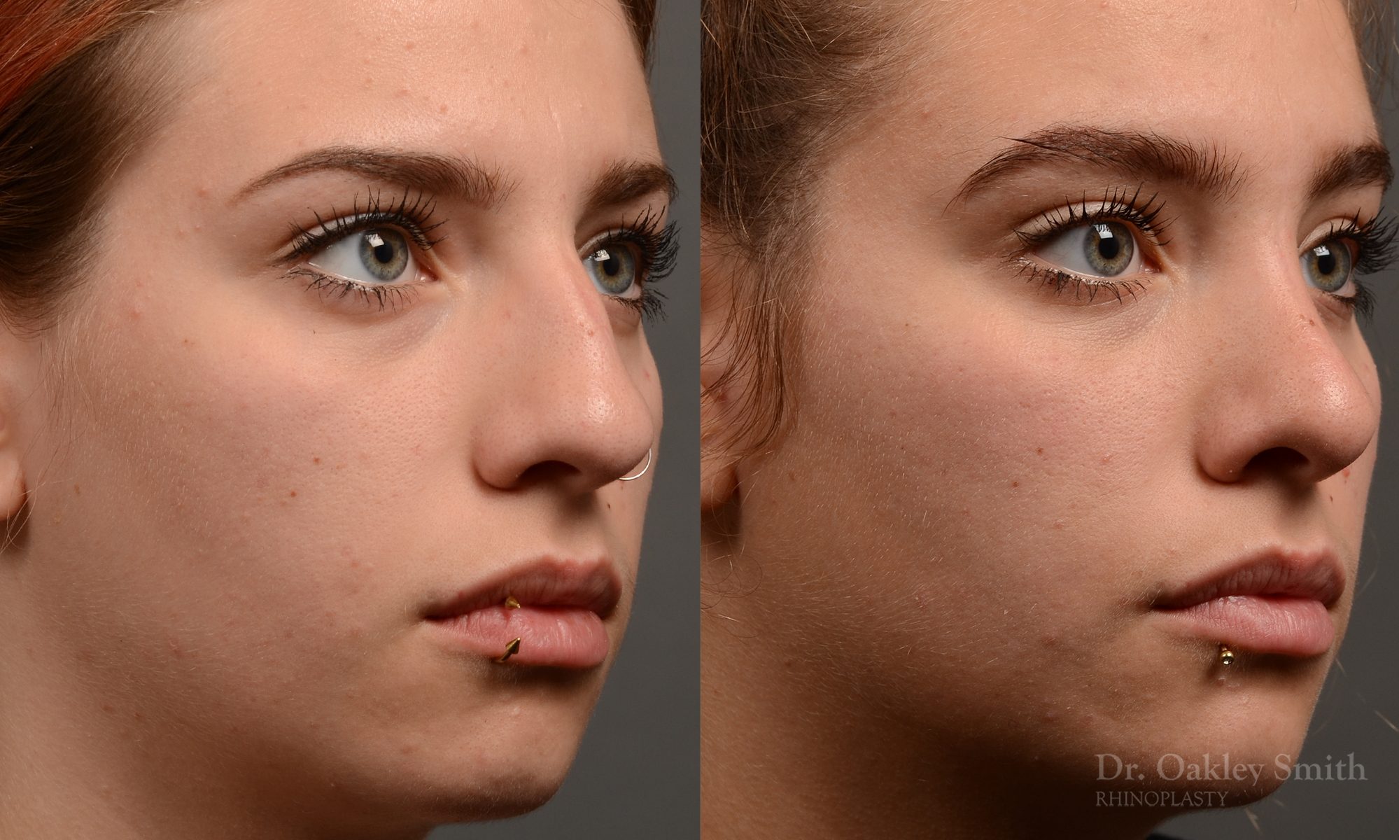 rhinoplasty Nothing demonstrates the skillful craftsmanship that Dr. Oakley Smith accomplishes during his surgeries than a collection of before and after case studies. As one of a hand full of surgeons in North America who limits his practice to only Rhinoplasty surgery, it is obvious that he has mastered his art. There is no question why he is one of the busiest cosmetic nose job surgeons in the country.