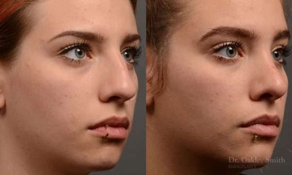 rhinoplasty Nothing demonstrates the skillful craftsmanship that Dr. Oakley Smith accomplishes during his surgeries than a collection of before and after case studies. As one of a hand full of surgeons in North America who limits his practice to only Rhinoplasty surgery, it is obvious that he has mastered his art. There is no question why he is one of the busiest cosmetic nose job surgeons in the country.
