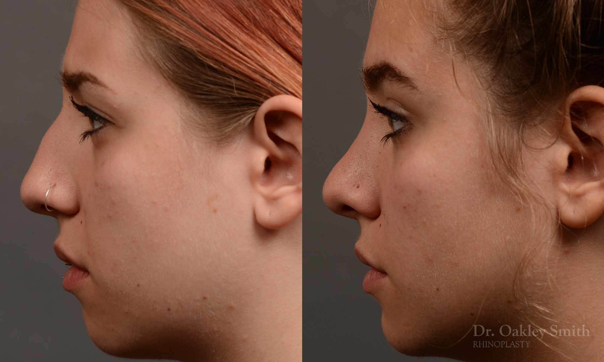 rhinoplasty Nothing demonstrates the skillful craftsmanship that Dr. Oakley Smith accomplishes during his surgeries than a collection of before and after case studies. As one of a hand full of surgeons in North America who limits his practice to only Rhinoplasty surgery, it is obvious that he has mastered his art. There is no question why he is one of the busiest cosmetic nose job surgeons in the country.