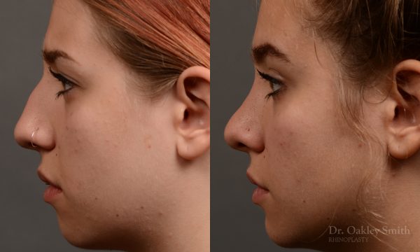 rhinoplasty Nothing demonstrates the skillful craftsmanship that Dr. Oakley Smith accomplishes during his surgeries than a collection of before and after case studies. As one of a hand full of surgeons in North America who limits his practice to only Rhinoplasty surgery, it is obvious that he has mastered his art. There is no question why he is one of the busiest cosmetic nose job surgeons in the country.