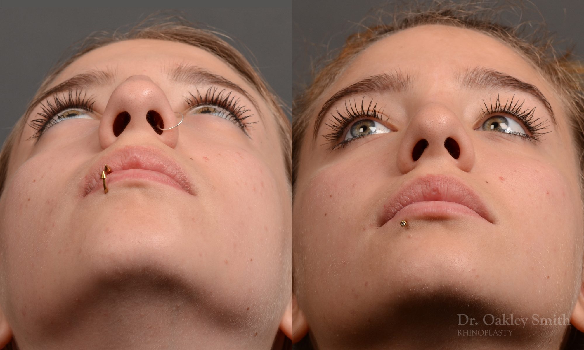 rhinoplasty Nothing demonstrates the skillful craftsmanship that Dr. Oakley Smith accomplishes during his surgeries than a collection of before and after case studies. As one of a hand full of surgeons in North America who limits his practice to only Rhinoplasty surgery, it is obvious that he has mastered his art. There is no question why he is one of the busiest cosmetic nose job surgeons in the country.