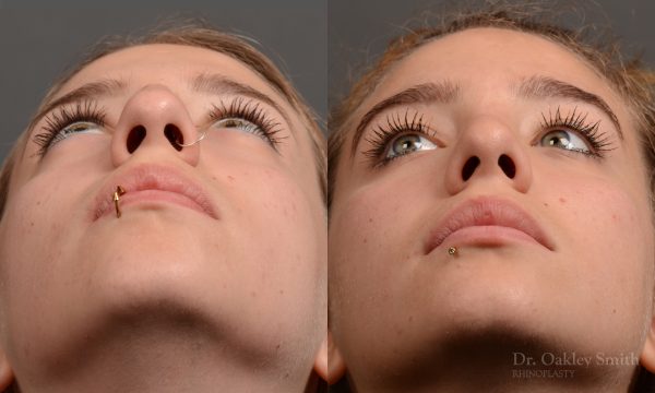 rhinoplasty Nothing demonstrates the skillful craftsmanship that Dr. Oakley Smith accomplishes during his surgeries than a collection of before and after case studies. As one of a hand full of surgeons in North America who limits his practice to only Rhinoplasty surgery, it is obvious that he has mastered his art. There is no question why he is one of the busiest cosmetic nose job surgeons in the country.