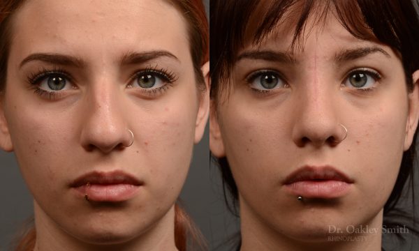 Rhinoplasty hump reduction on young women