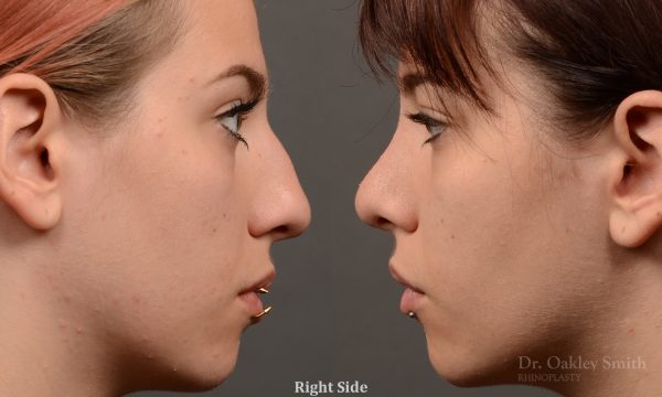 Rhinoplasty hump reduction on young women