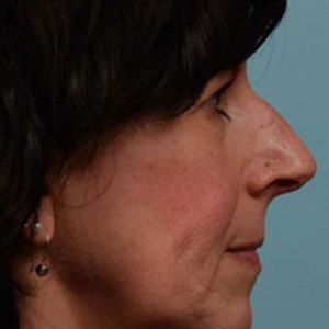 Hump Reduction, Rhinoplasty - Rhinoplasty Before and After Case 324