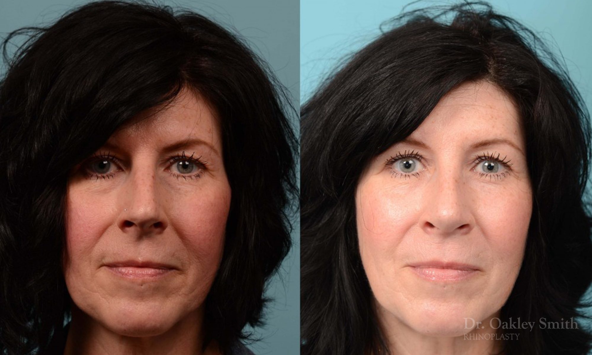 Hump reduction rhinoplasty on woman