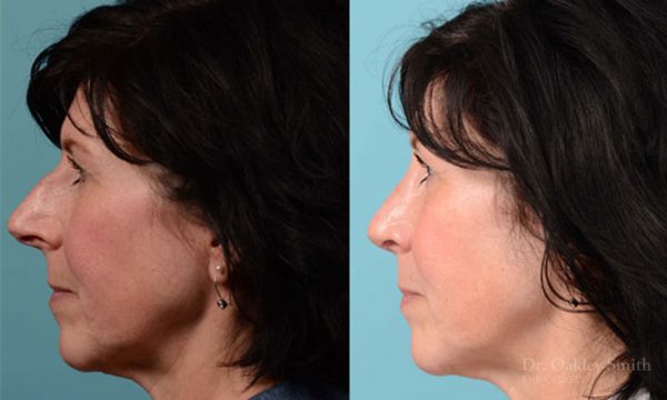 Hump reduction rhinoplasty on woman