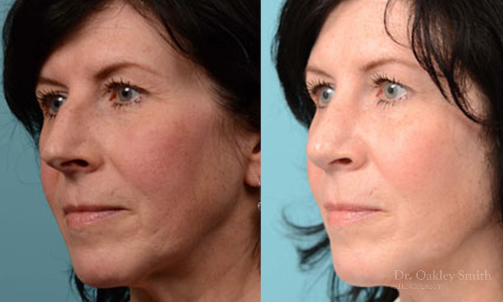 Hump reduction rhinoplasty on woman