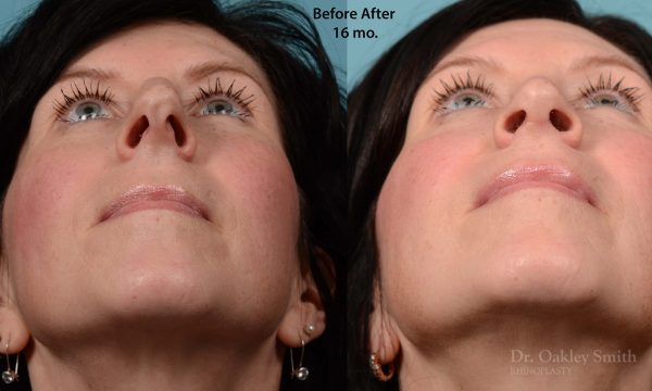 Hump reduction rhinoplasty on woman