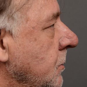 rhinoplasty OHIP nose surgery for breathing