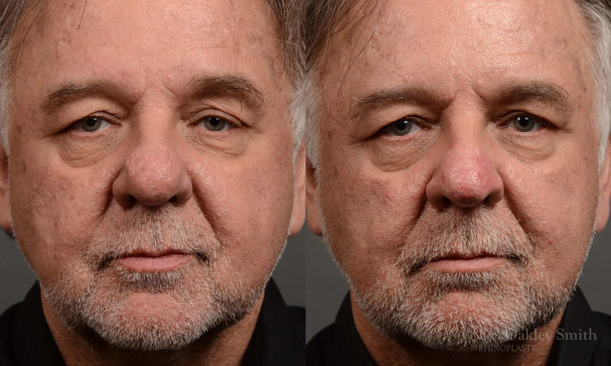 rhinoplasty OHIP nose surgery for breathing