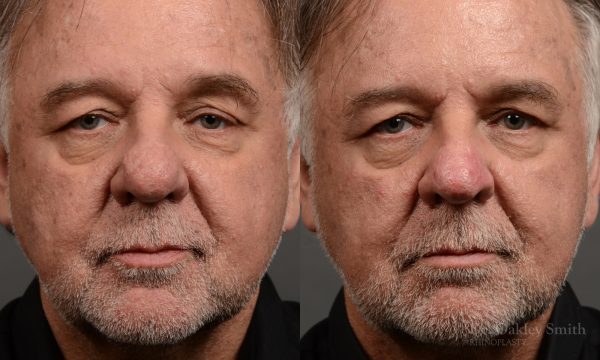 rhinoplasty OHIP nose surgery for breathing