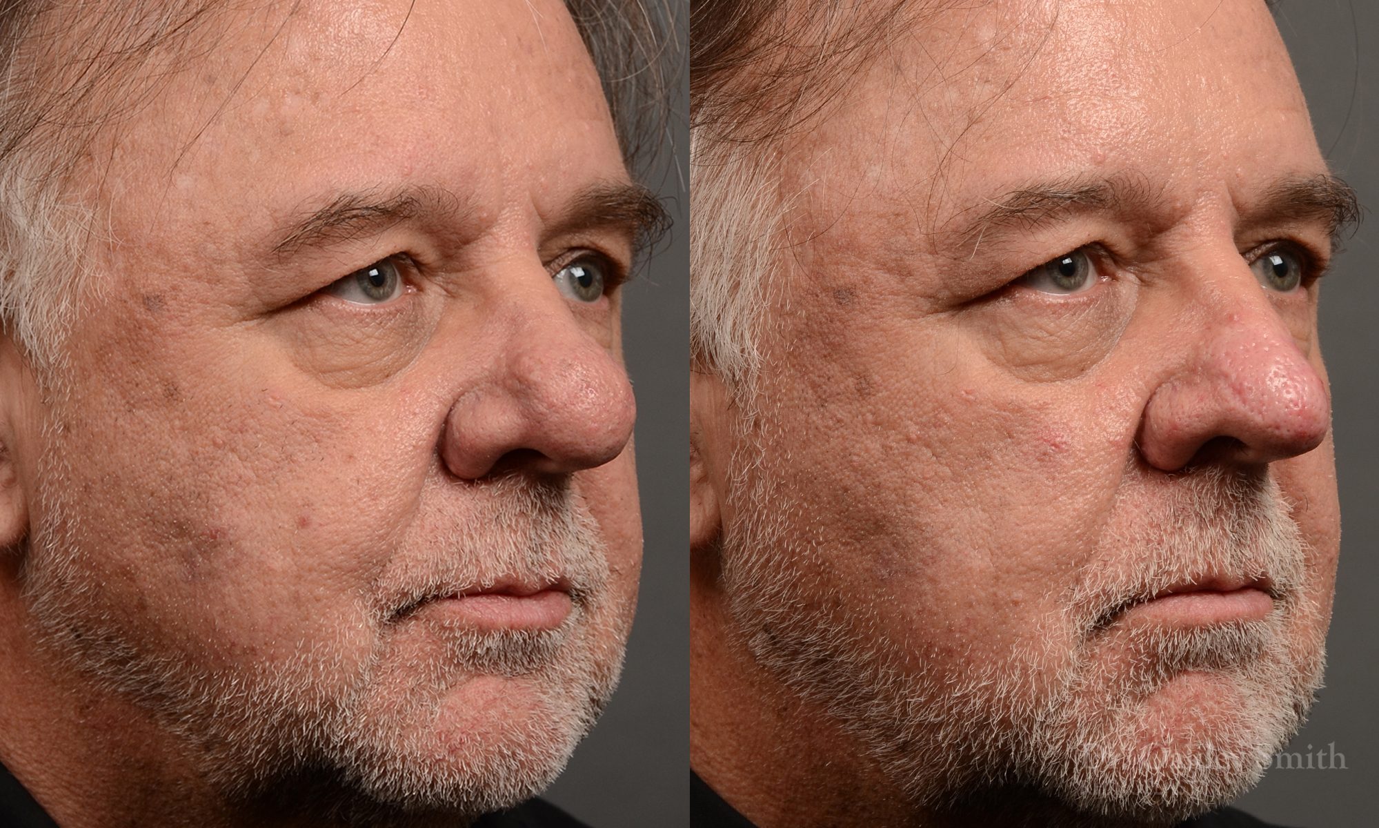 rhinoplasty OHIP nose surgery for breathing