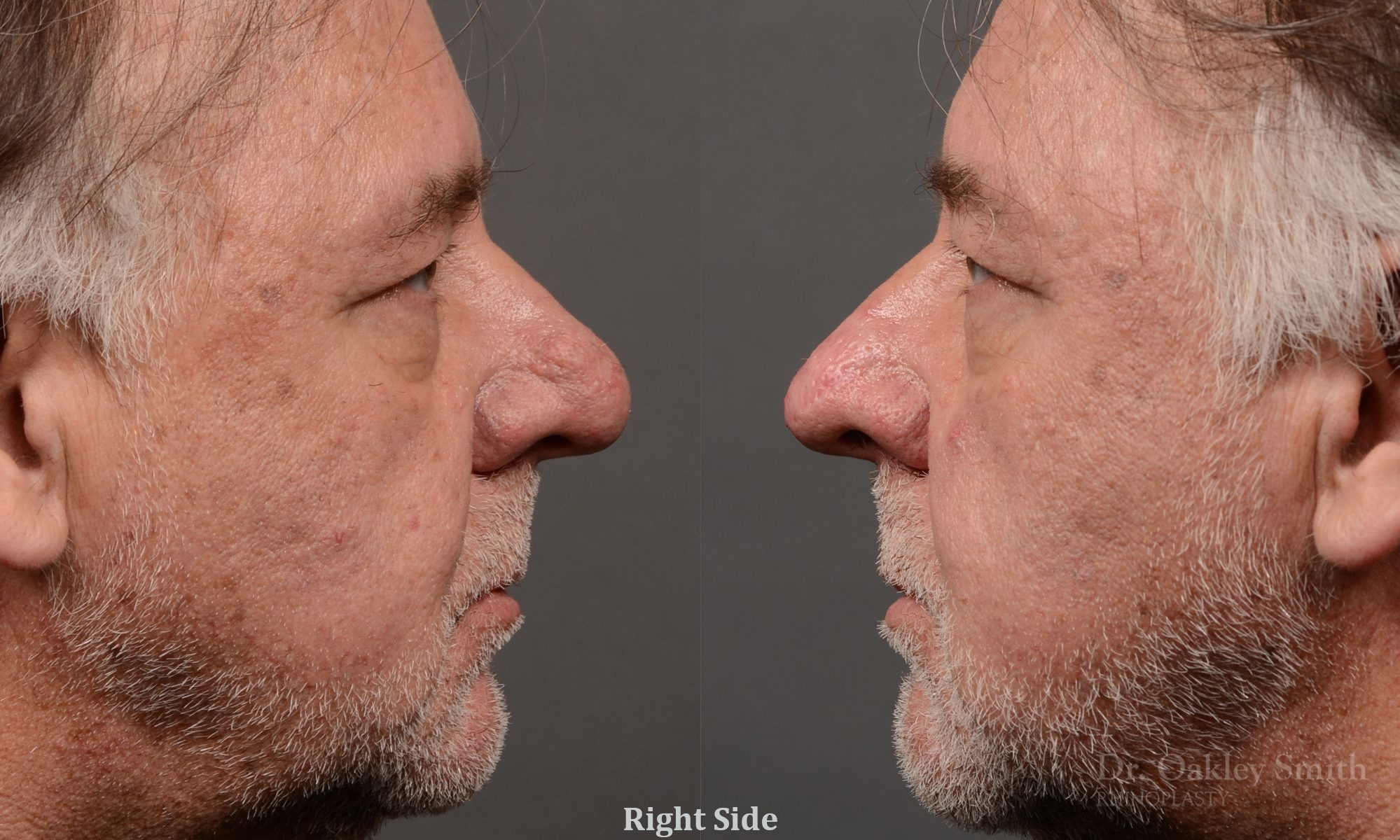 rhinoplasty OHIP nose surgery for breathing