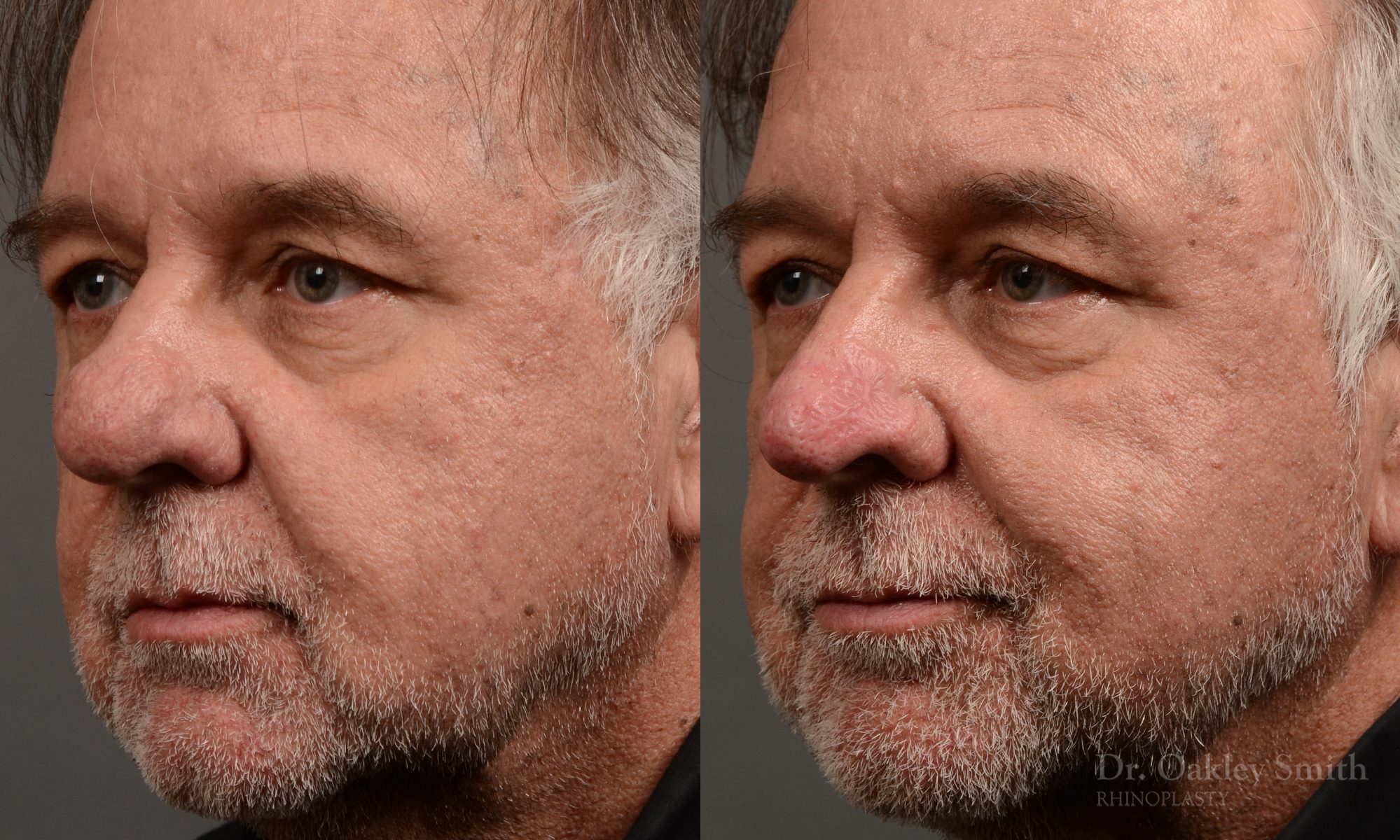 rhinoplasty OHIP nose surgery for breathing