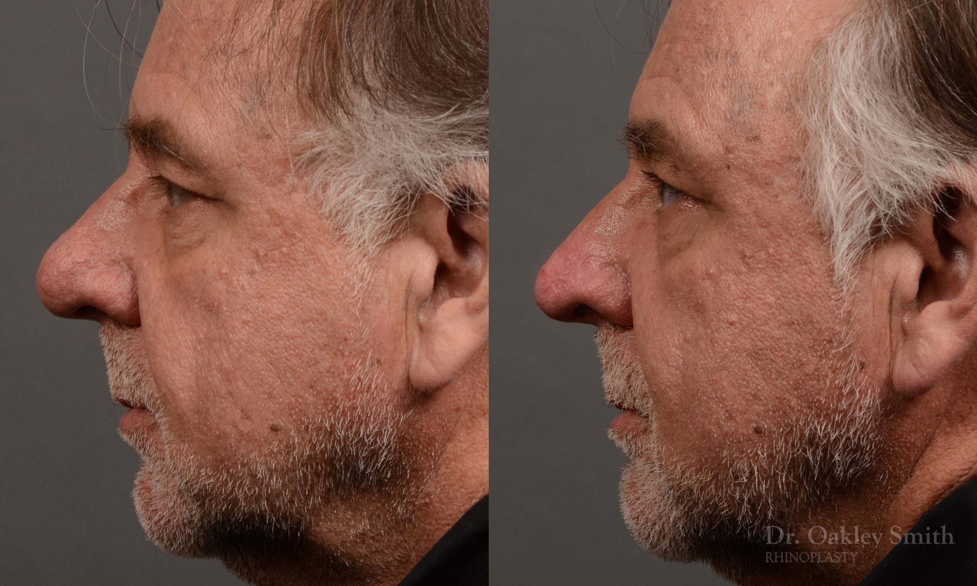rhinoplasty OHIP nose surgery for breathing