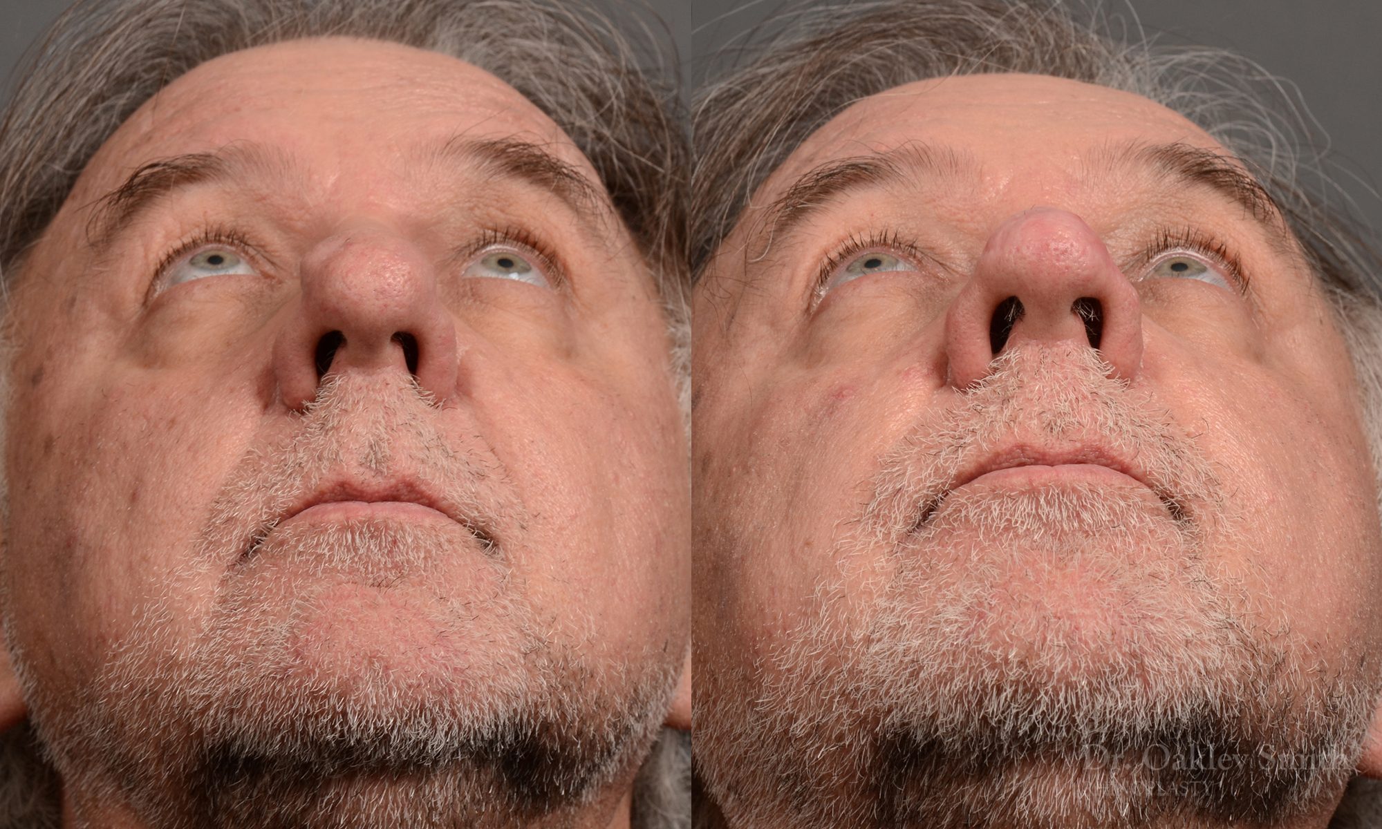 rhinoplasty OHIP nose surgery for breathing