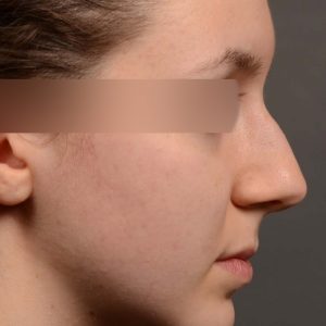 hump reduction rhinoplasty for asthetics