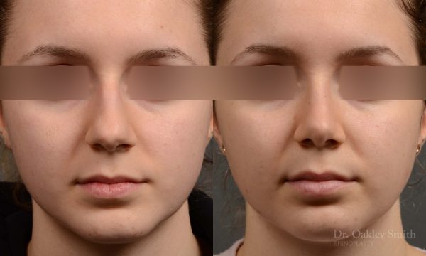 rhinoplasty Nothing demonstrates the skillful craftsmanship that Dr. Oakley Smith accomplishes during his surgeries than a collection of before and after case studies. As one of a hand full of surgeons in North America who limits his practice to only Rhinoplasty surgery, it is obvious that he has mastered his art. There is no question why he is one of the busiest cosmetic nose job surgeons in the country.