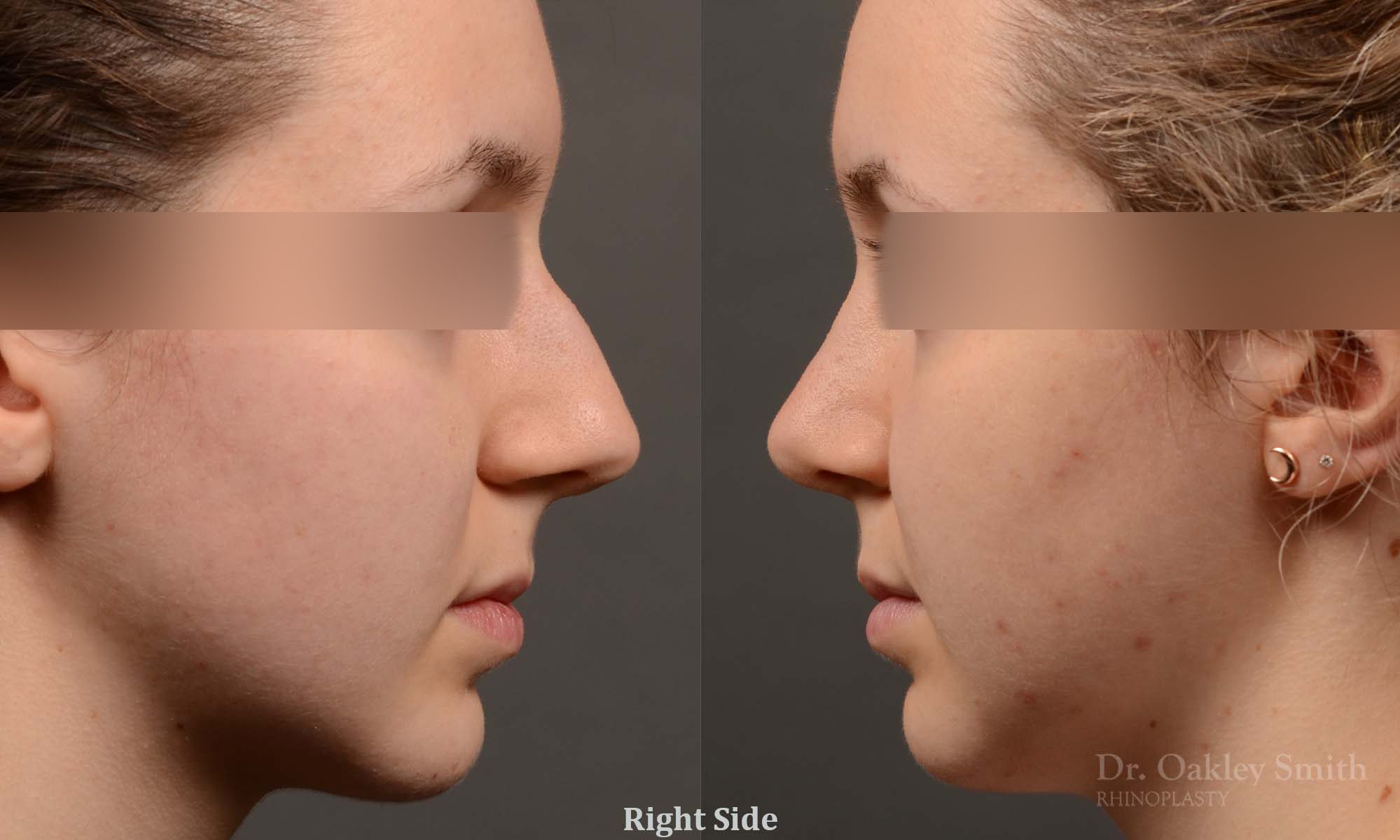 rhinoplasty Nothing demonstrates the skillful craftsmanship that Dr. Oakley Smith accomplishes during his surgeries than a collection of before and after case studies. As one of a hand full of surgeons in North America who limits his practice to only Rhinoplasty surgery, it is obvious that he has mastered his art. There is no question why he is one of the busiest cosmetic nose job surgeons in the country.