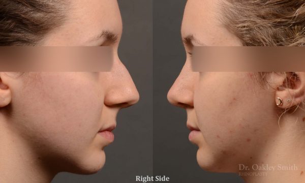 rhinoplasty Nothing demonstrates the skillful craftsmanship that Dr. Oakley Smith accomplishes during his surgeries than a collection of before and after case studies. As one of a hand full of surgeons in North America who limits his practice to only Rhinoplasty surgery, it is obvious that he has mastered his art. There is no question why he is one of the busiest cosmetic nose job surgeons in the country.