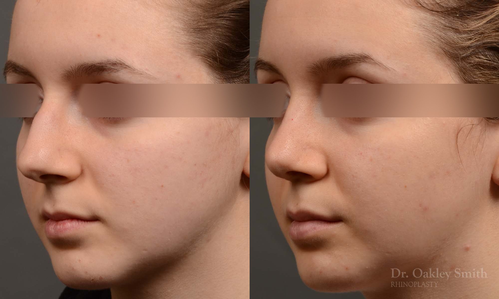 rhinoplasty Nothing demonstrates the skillful craftsmanship that Dr. Oakley Smith accomplishes during his surgeries than a collection of before and after case studies. As one of a hand full of surgeons in North America who limits his practice to only Rhinoplasty surgery, it is obvious that he has mastered his art. There is no question why he is one of the busiest cosmetic nose job surgeons in the country.