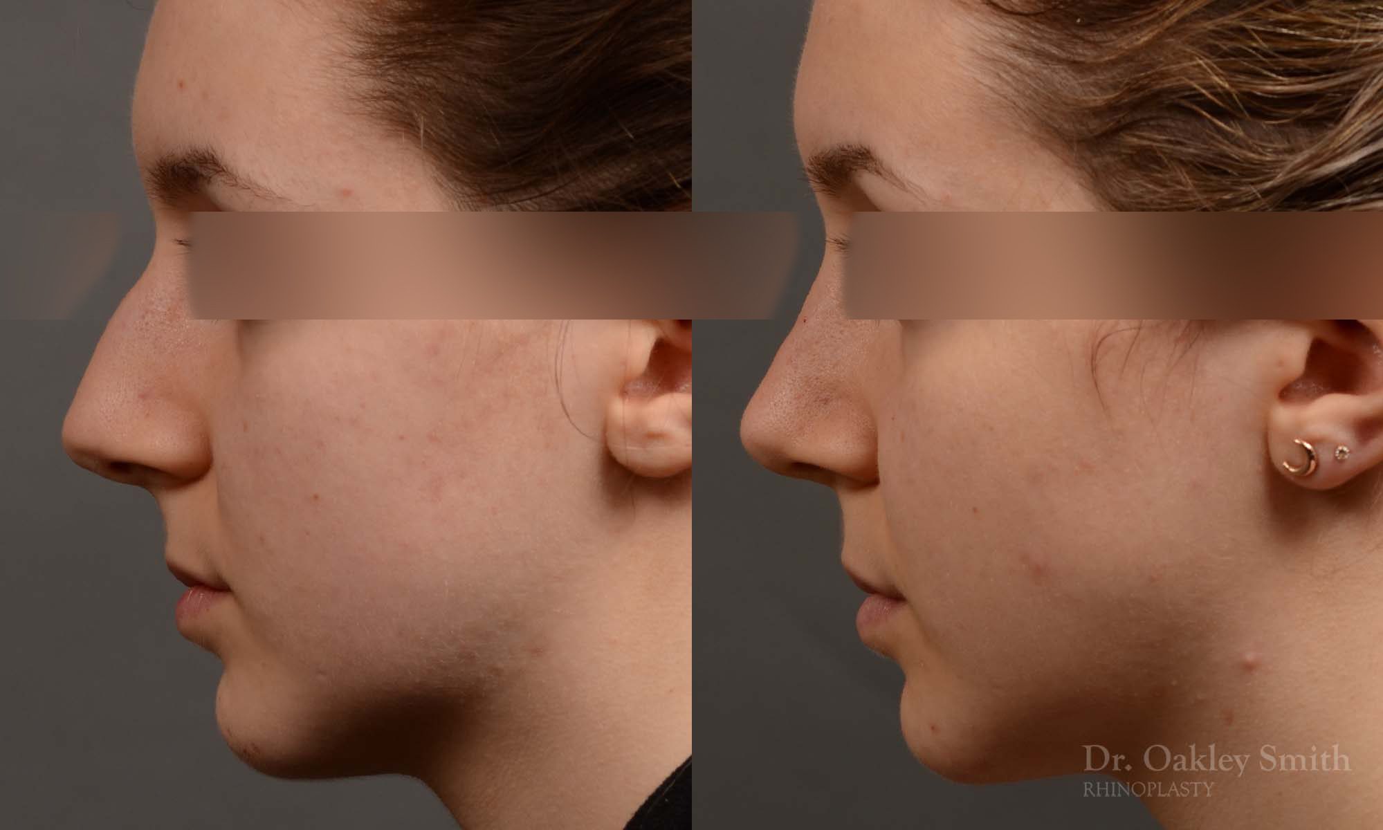 rhinoplasty Nothing demonstrates the skillful craftsmanship that Dr. Oakley Smith accomplishes during his surgeries than a collection of before and after case studies. As one of a hand full of surgeons in North America who limits his practice to only Rhinoplasty surgery, it is obvious that he has mastered his art. There is no question why he is one of the busiest cosmetic nose job surgeons in the country.