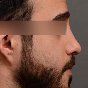 OHIP male rhinoplasty dr oakley smith