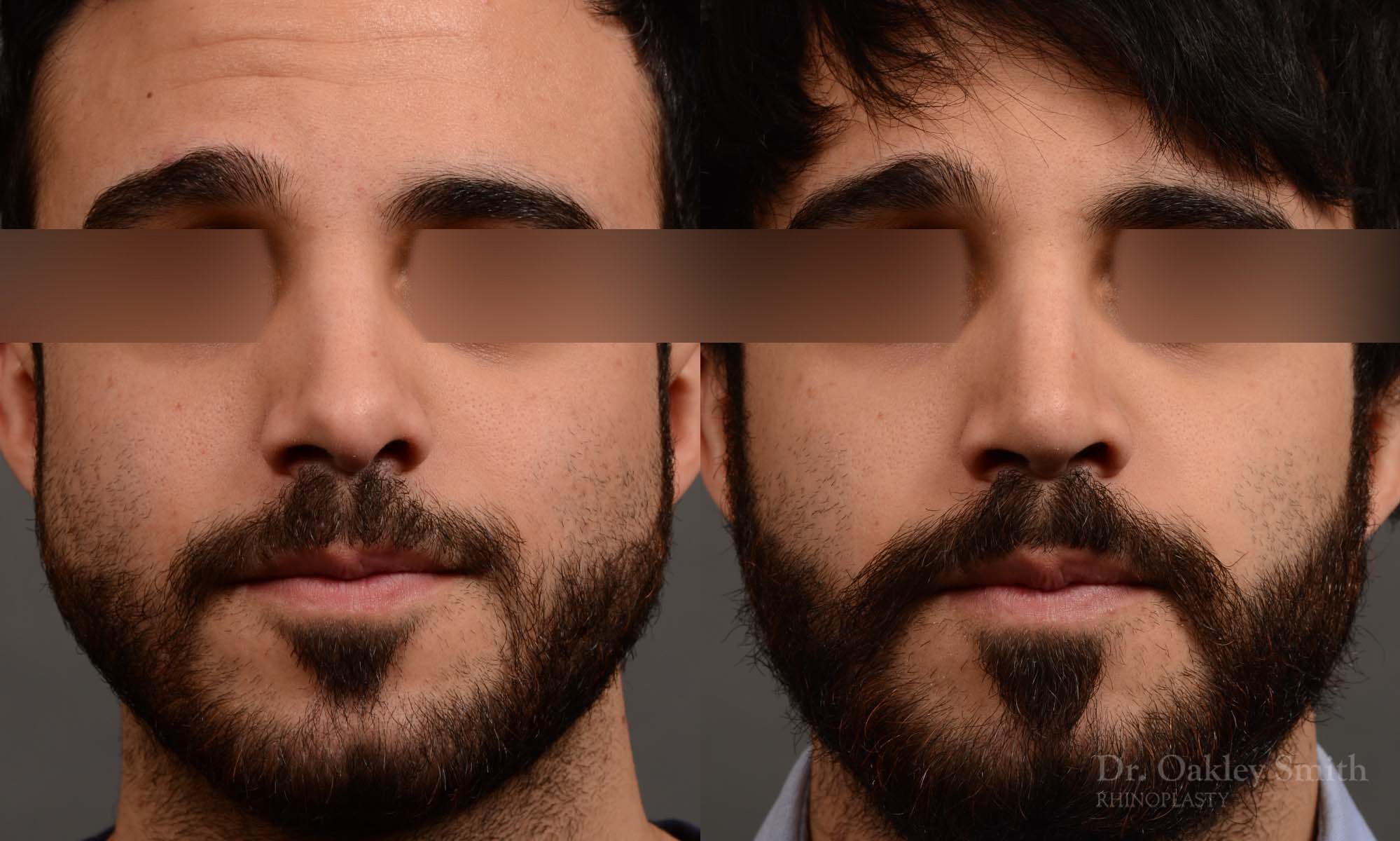 Male revision rhinoplasty