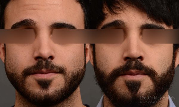 Male revision rhinoplasty