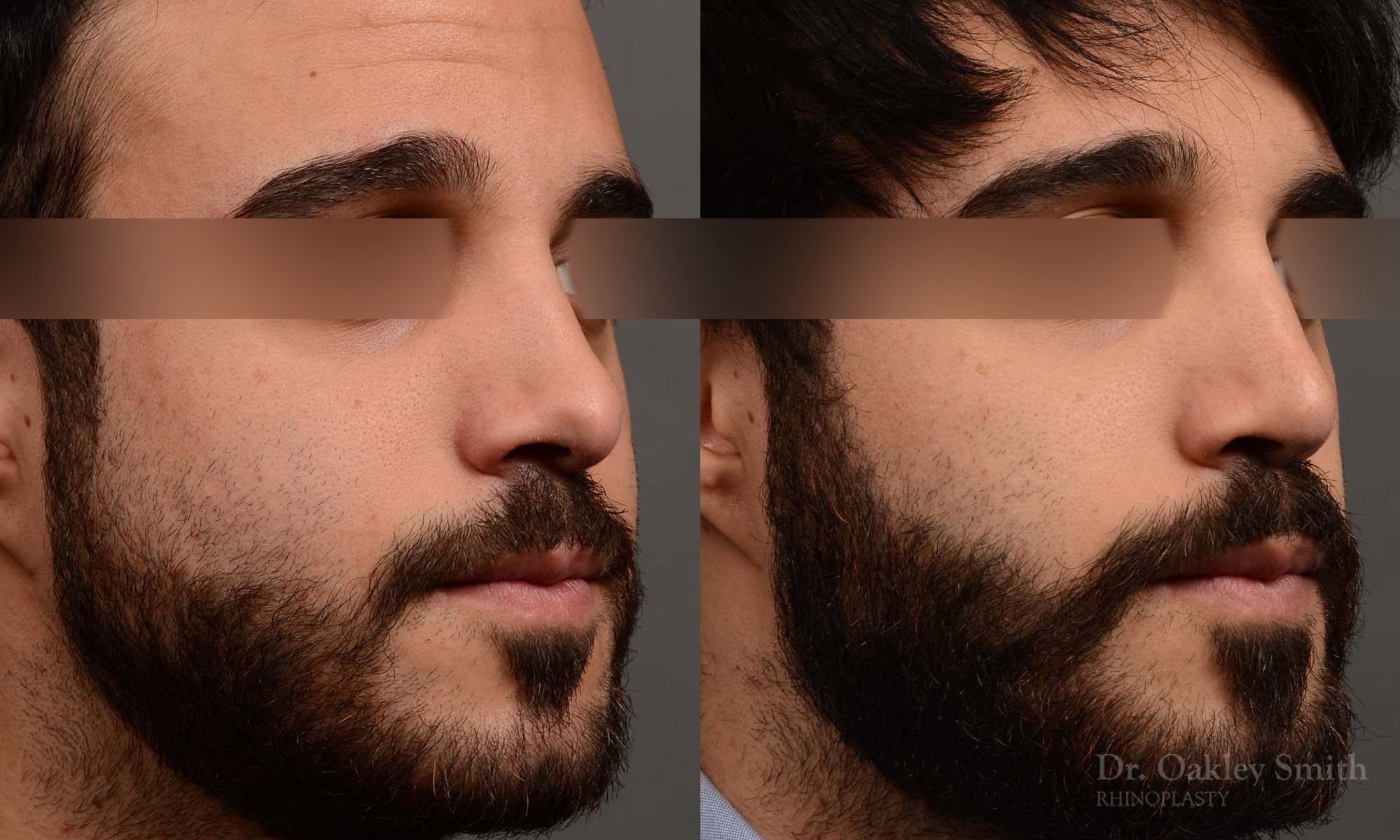 Male revision rhinoplasty