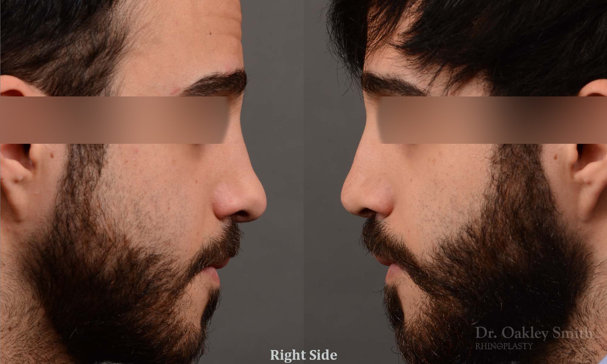 Male revision rhinoplasty