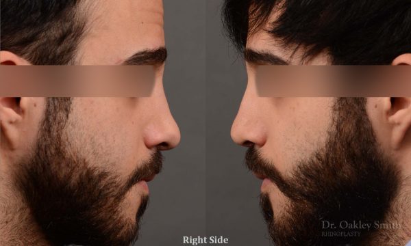 Male revision rhinoplasty