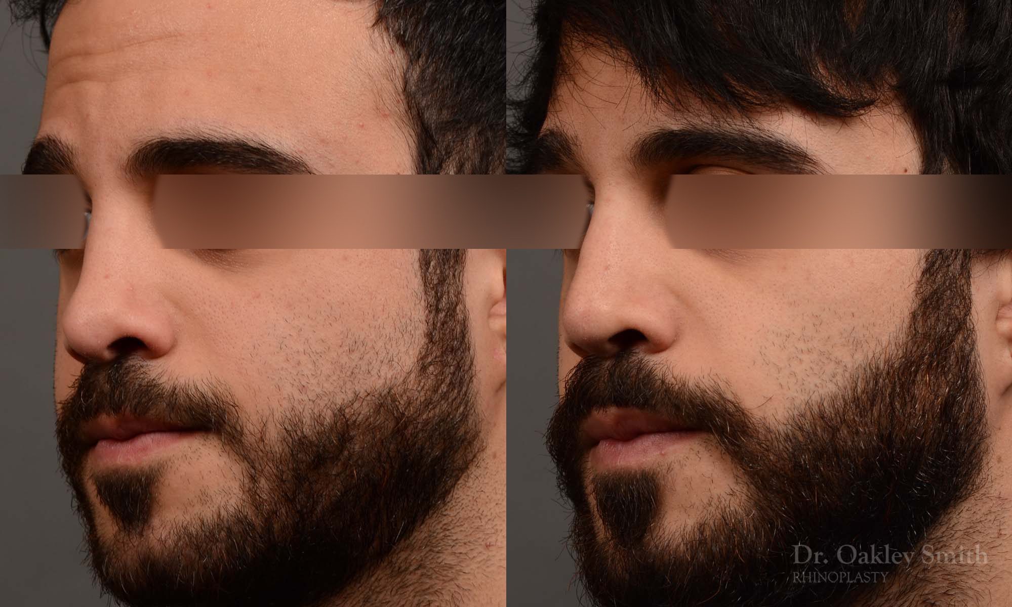 Male revision rhinoplasty