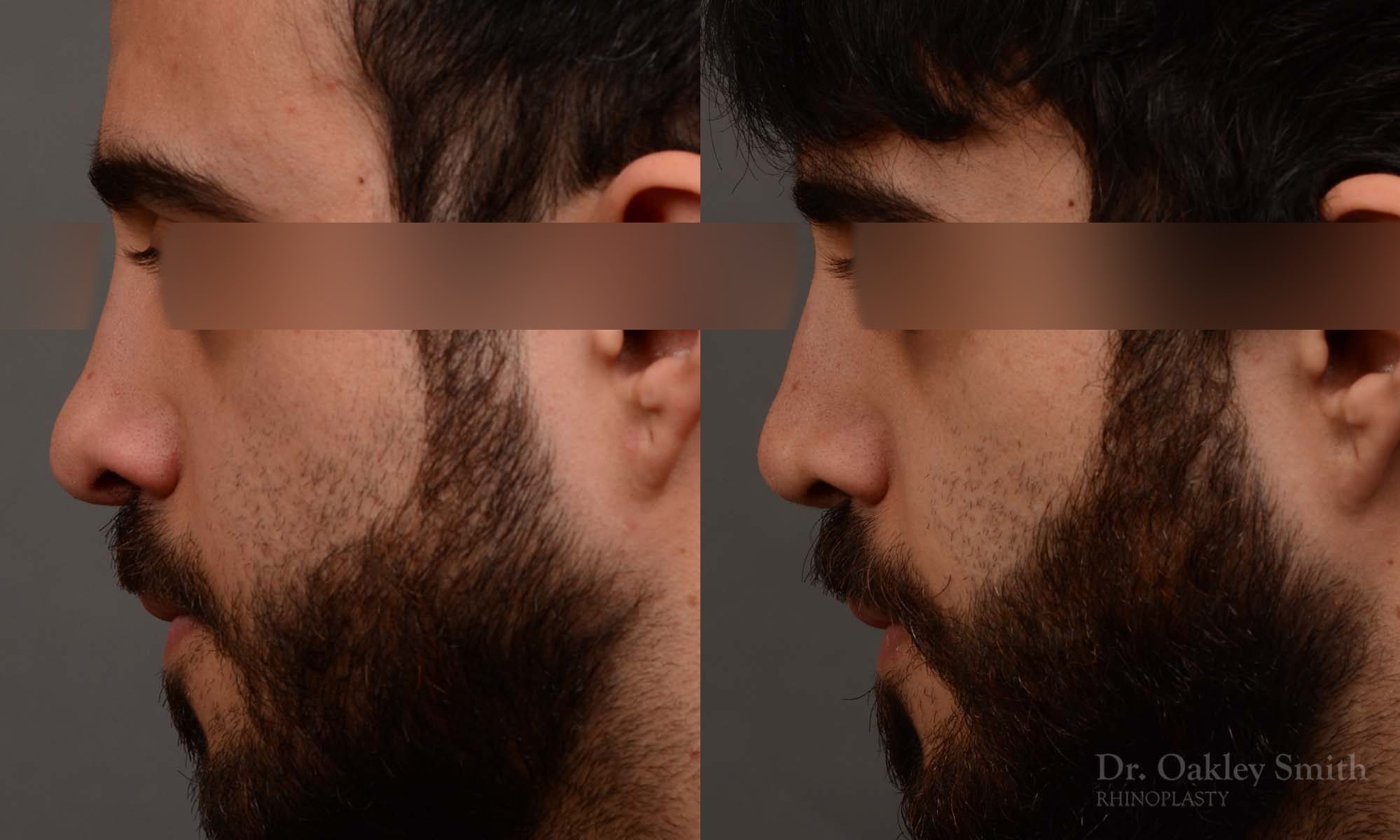Male revision rhinoplasty