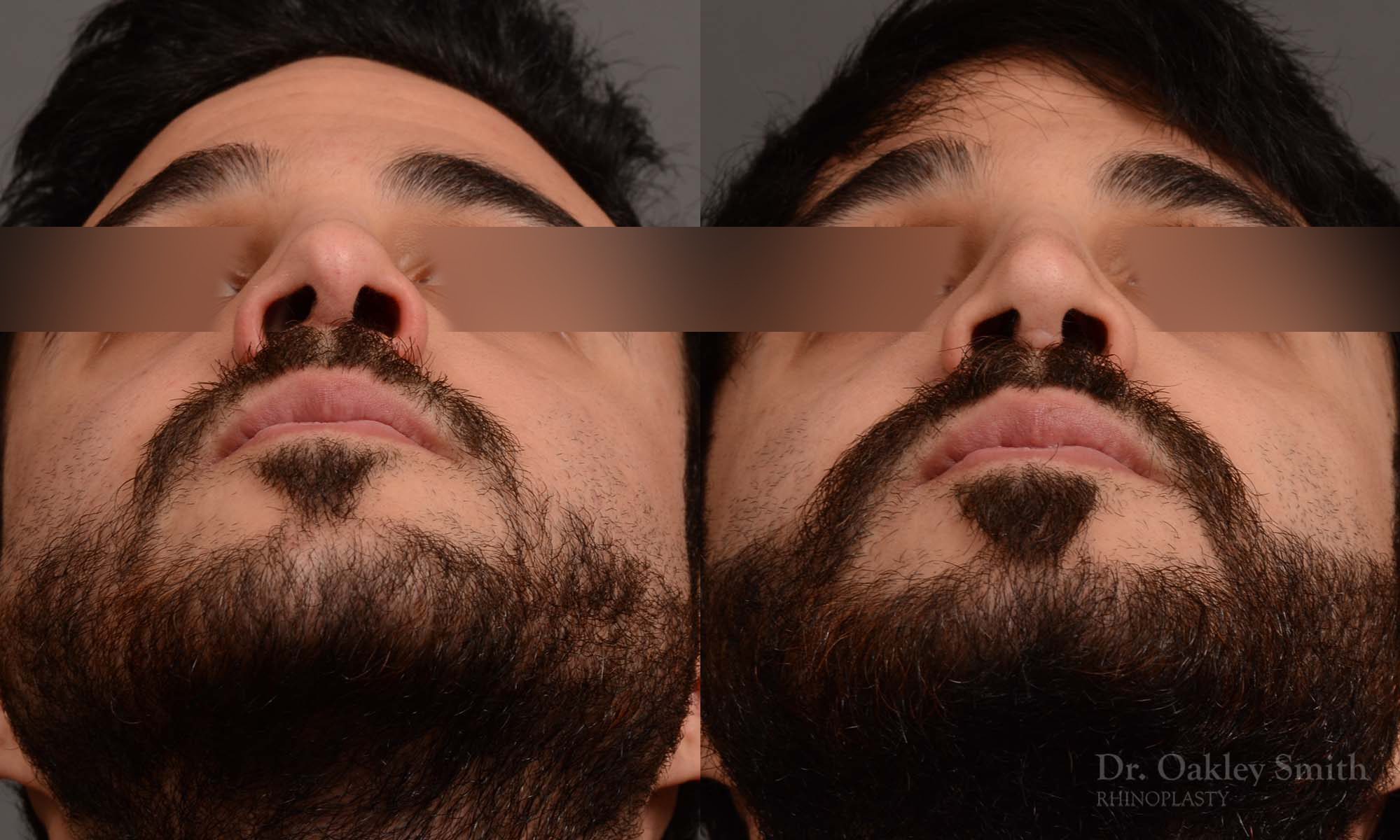 Male revision rhinoplasty