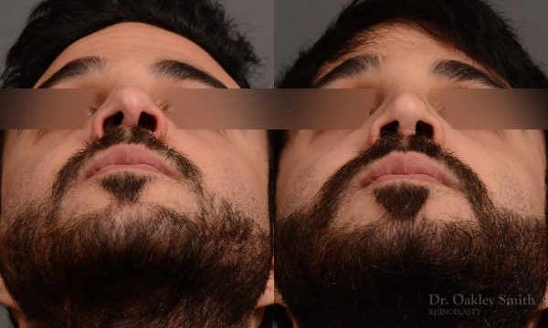 Male revision rhinoplasty