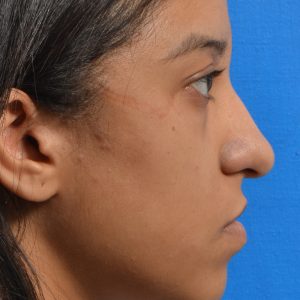 Female rhinoplasty for hump removal.