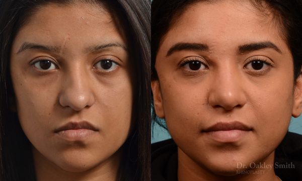 Female rhinoplasty for hump removal.