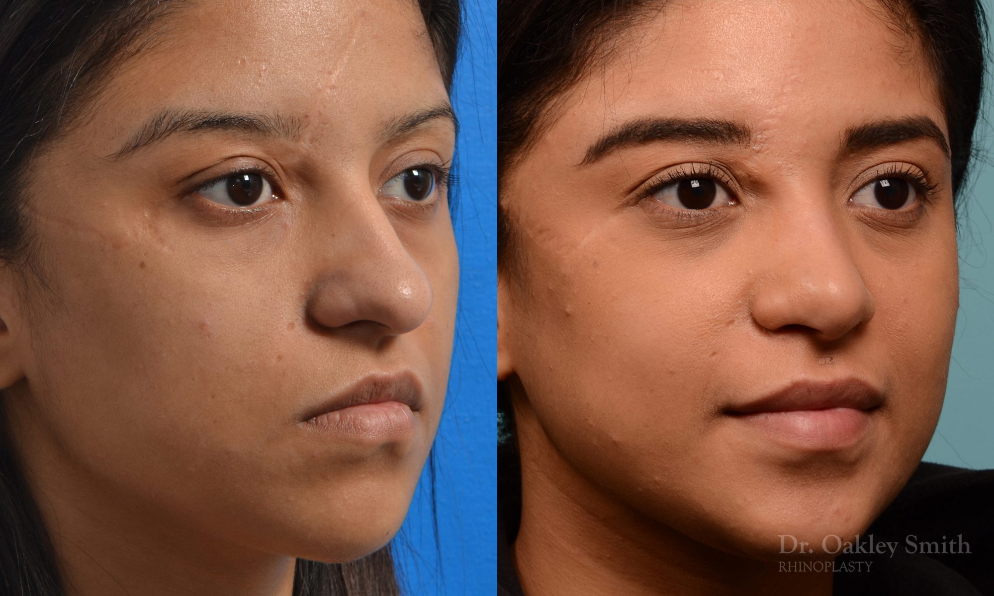 Female rhinoplasty for hump removal.