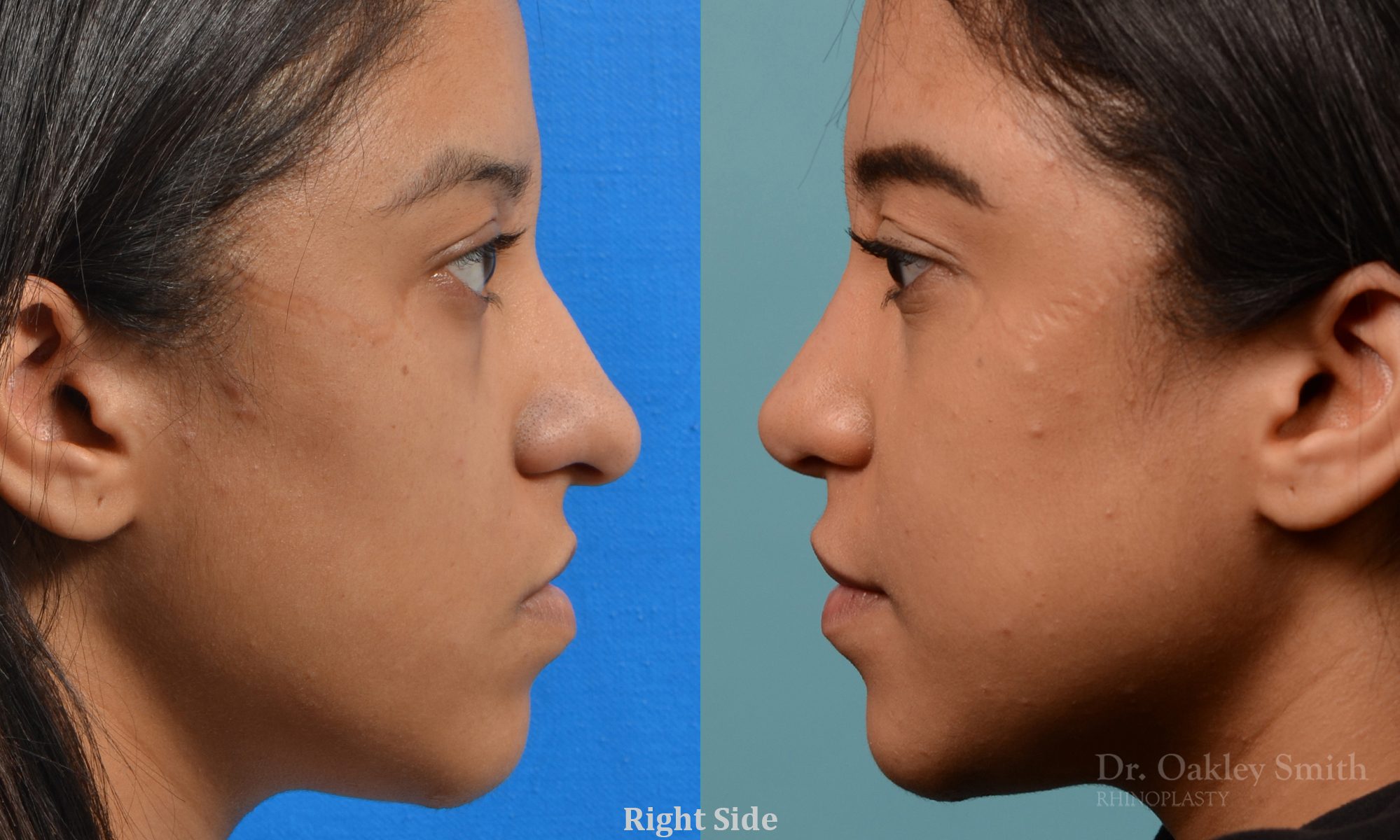 Female rhinoplasty for hump removal.