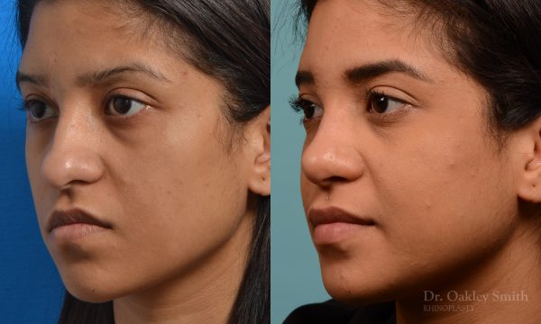Female rhinoplasty for hump removal.