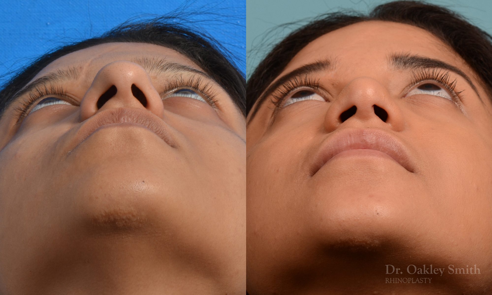 Female rhinoplasty for hump removal.