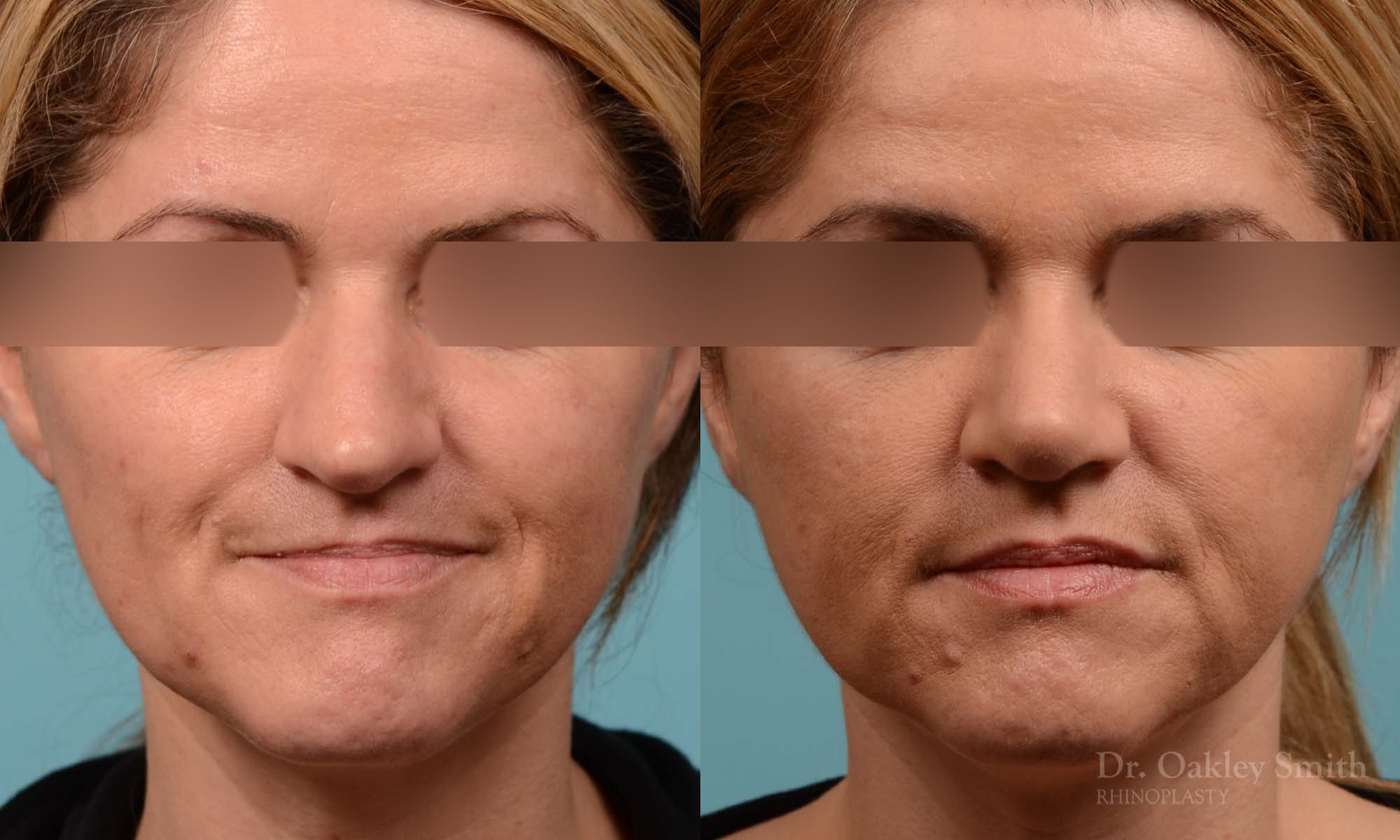 rhinoplasty nose reduction female