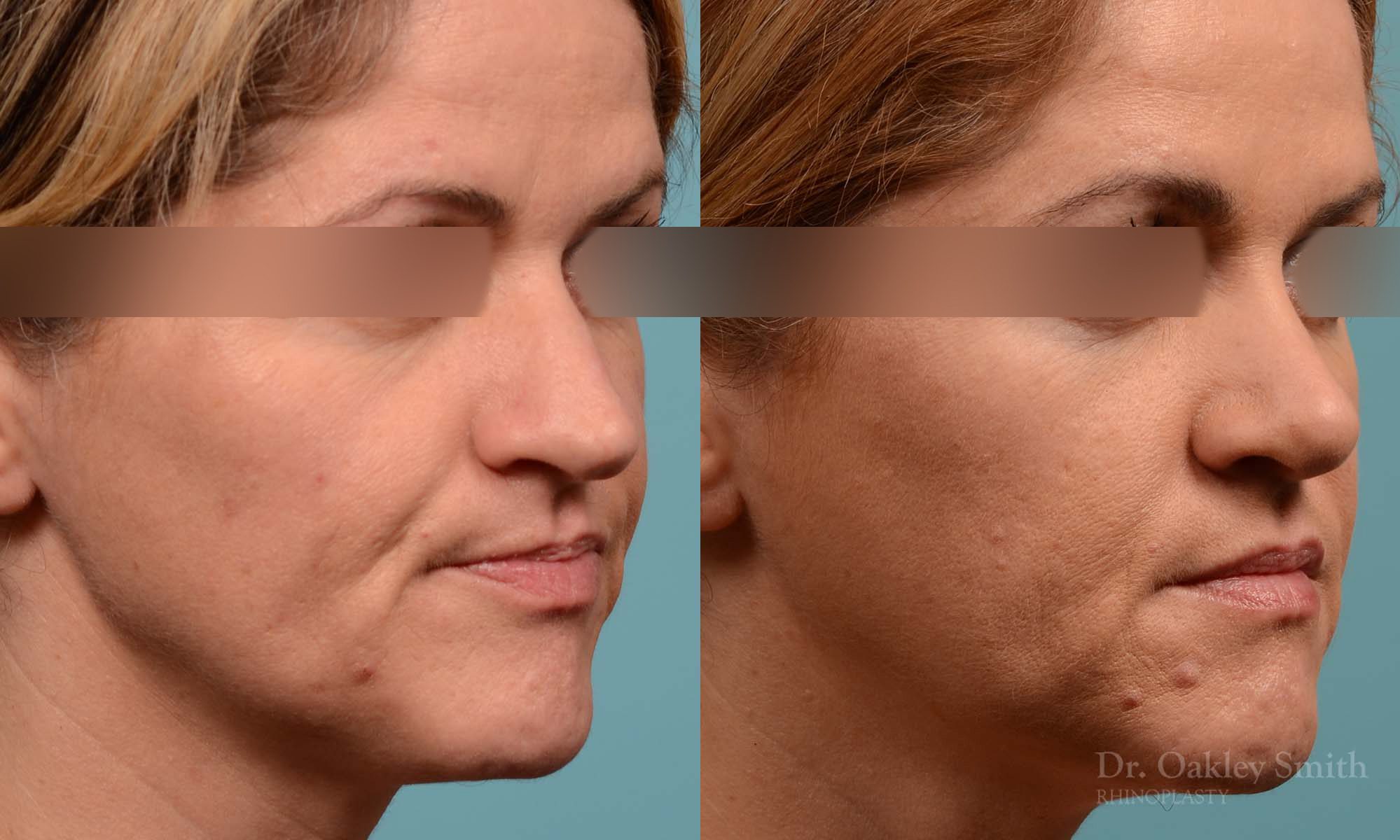 rhinoplasty nose reduction female
