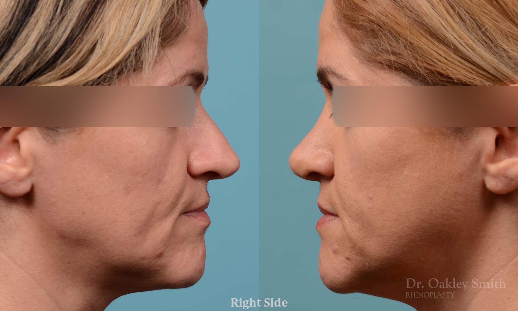 rhinoplasty nose reduction female